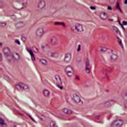 Secondary Lung Cancer Photograph By Cnri Science Photo Library Pixels