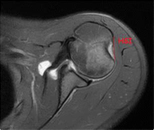 An Axial Cut On An MRI Of The Shoulder Demonstrating The Hill Sachs