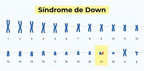 Síndrome de Down qué es y características en los niños