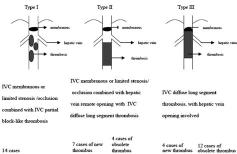 Forty One Patients With Budd Chiari Syndrome Bcs And Inferior Vena