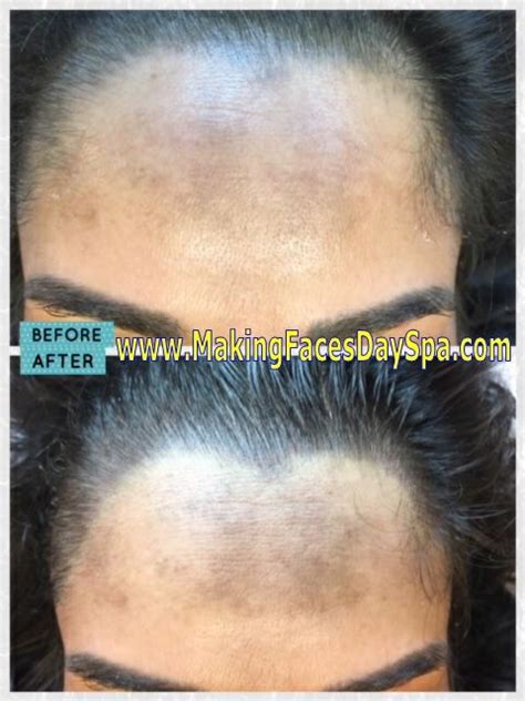 12 Best Microblading Hairline And Bald Spot Restoration Images By