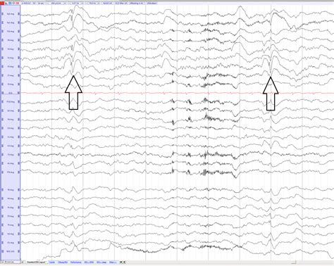 Spike Slow Wave Complex Eegpedia