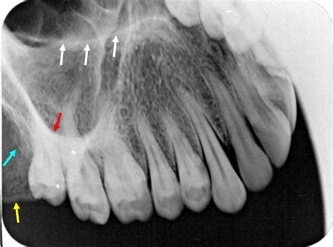 Zygomatic Arch Radiograph