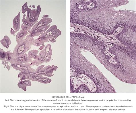 Pathology Outlines Squamous Papilloma