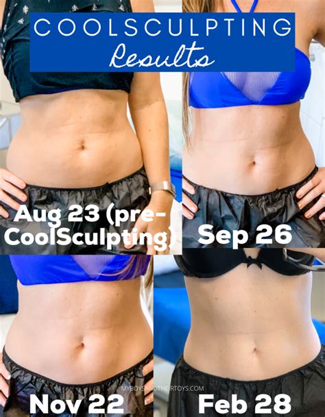 Diy Coolsculpting Before And After Terrie Aguiar