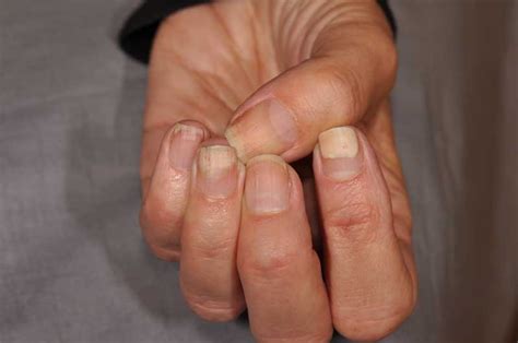 Toenail Bed Receding At Bennytjohnsono Blog