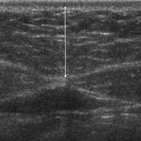 Ultrasonogram Of Preperitoneal Fat The Thickness Of Preperitoneal Fat
