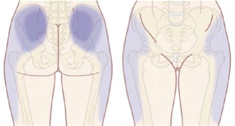 Lumbar facet syndrome | OsteoMag