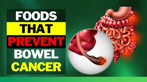 Foods That Prevent Bowel Cancer And Colon Polyps Youtube