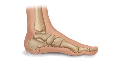 What Are Heel Spurs Learn Symptoms Causes And Treatment