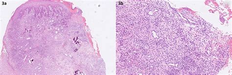 Frontiers Case Report Necrotizing Stomatitis As A Manifestation Of