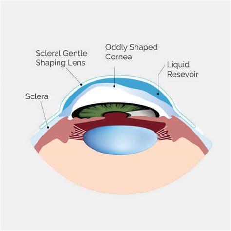 Scleral Contact Lenses Keratoconus