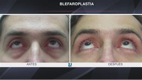 Blefaroplastia Antes Y Despu S En Gente Joven Precios En