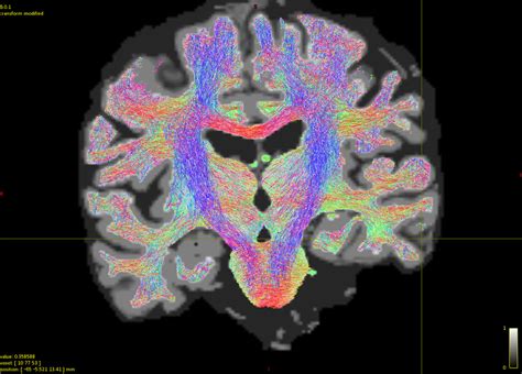 Whole brain tractogram - tractography - MRtrix3 Community