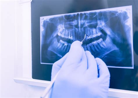 How Much Radiation Do You Get From Dental X-Rays? - DDP