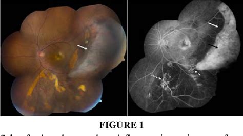 Figure 1 From Retinal Pigment Epithelial Tears In The Era Of