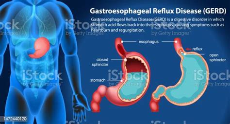 Gastroesophageal Reflux Disease Diagram Stock Illustration Download Image Now