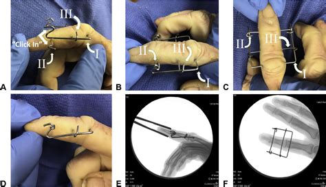 Dynamic Homemade Digital External Fixators For Proximal