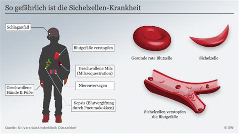 Zehn Fragen Und Antworten Zur Sichelzellen Krankheit Wissen Umwelt