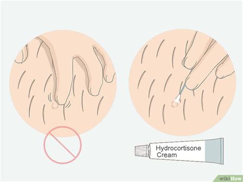 Antibiotic Cream For Ingrown Pubic Hair