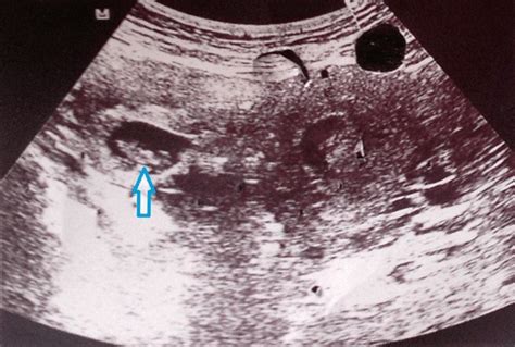 On Transvaginal Sonography Of The Right Adnexa A Gestational Sac Blue Download Scientific