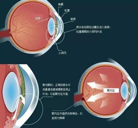 山东省微创治疗先天性青光眼新技术30上线，了解一下澎湃号·政务澎湃新闻 The Paper