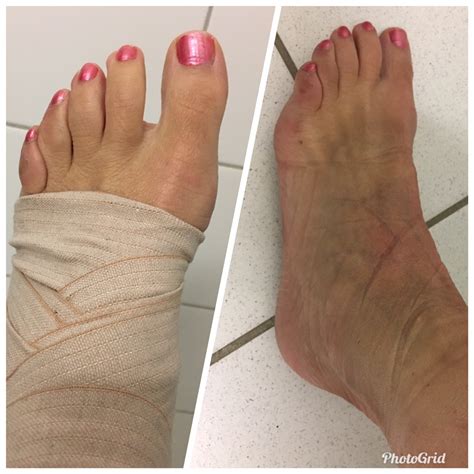 nu med forstuvet fod mammalade