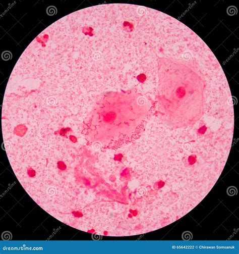 Red Leukocyte in Sputum Gram Stain Stock Photo - Image of illness ...