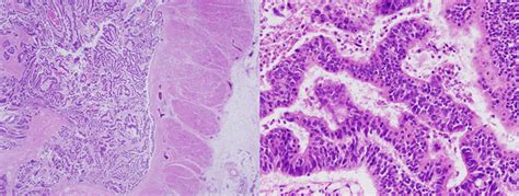 Postmortem Rectal Biopsy Hematoxylin And Eosin Stain Showing Rectal Download Scientific