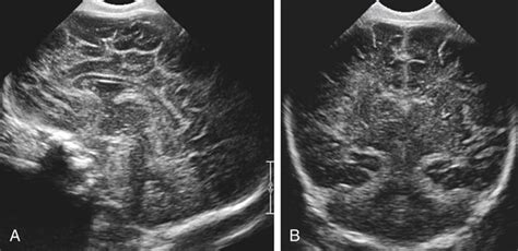 Premature Birth Rule Out Germinal Matrix Hemorrhage Radiology Key