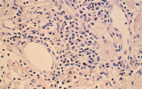 Nodular Amyloidosis Review And Long Term Follow Up Of 16 Cases