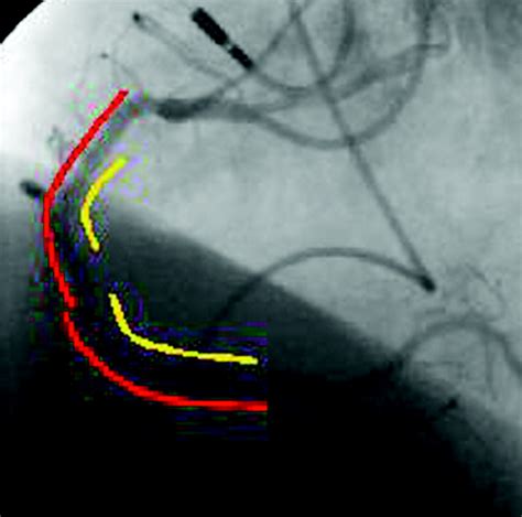 Percutaneous Coronary Intervention II The Procedure The BMJ