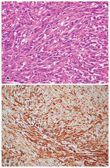 Xeroderma Pigmentosum Histology