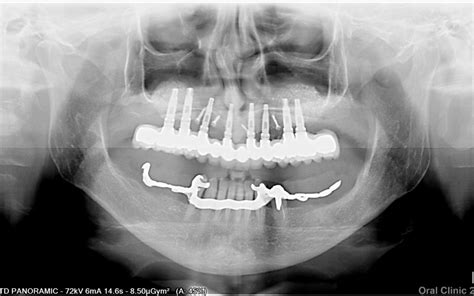 Pose Bridge Dents Sur Implants Et Elevation Du Sinus Comment