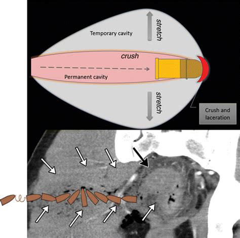 Imaging Evaluation Of Abdominopelvic Gunshot Trauma Radiographics