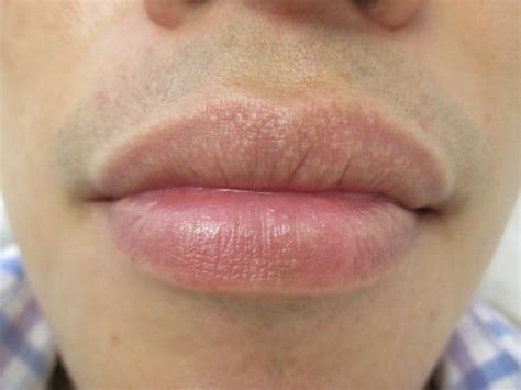 11 Tips To Prevent And Treat Fordyce Spots On Lips Milia On Lips