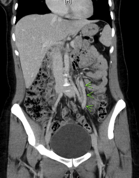 A Simplified Surgical Approach For Left Ovarian Vein Transposition For