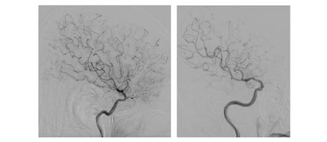 Digital Subtraction Angiography 6 Months After The Procedure Complete