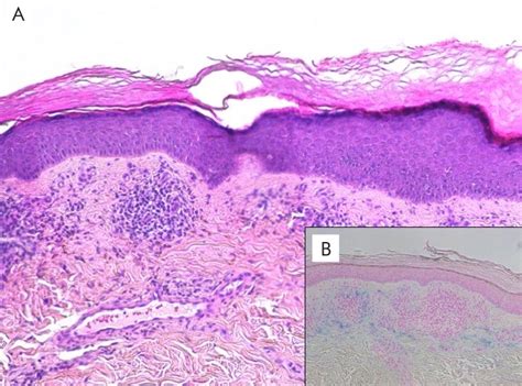 A Purpuric Pigmented Dermatosis Lymphocytic Cuffing Of Vessels And