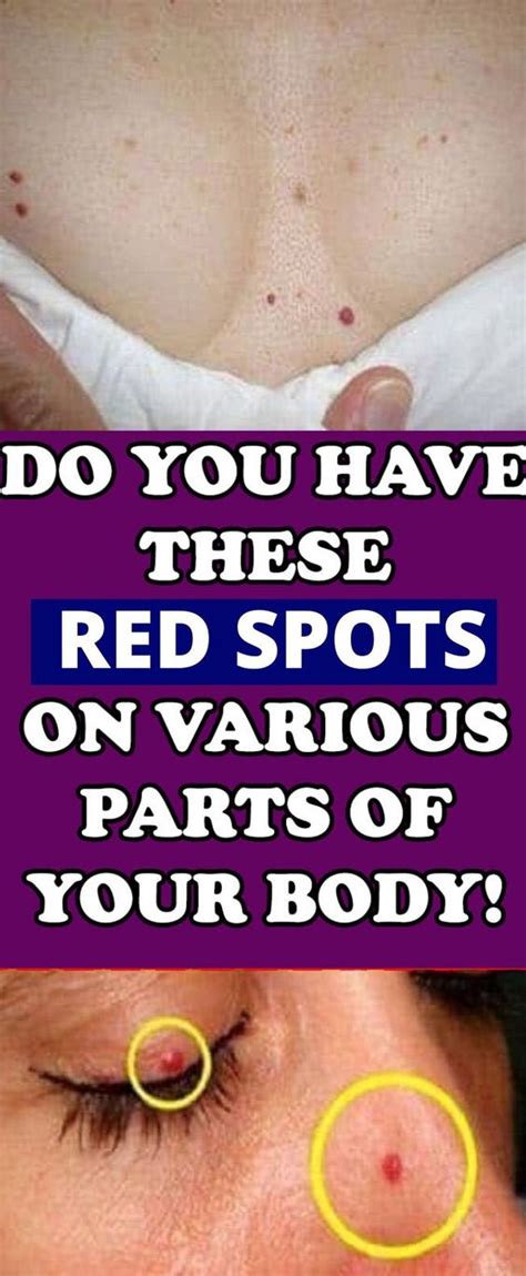 Do You Have These Red Spots On Various Parts Of Your Body Health