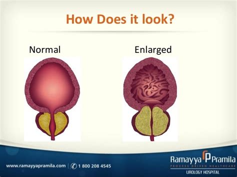 Benign Prostatic Hypertrophy