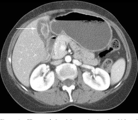 Figure 1 From Acute Acalculous Cholecystitis Associated With Acute Hepatitis B Virus Infection