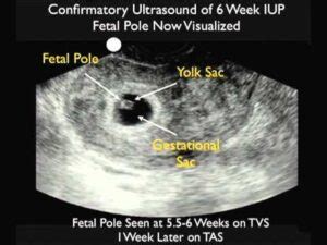 Fetal Pole - radiologystar