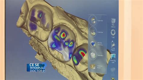 De ce implanturile dentare sunt mai bune decât punţile Știrile ProTV