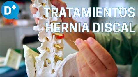 Causas Y Tratamientos De La Hernia Discal Youtube