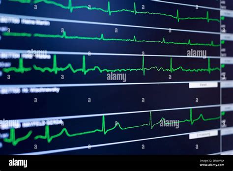Ekg Chart Hi Res Stock Photography And Images Alamy