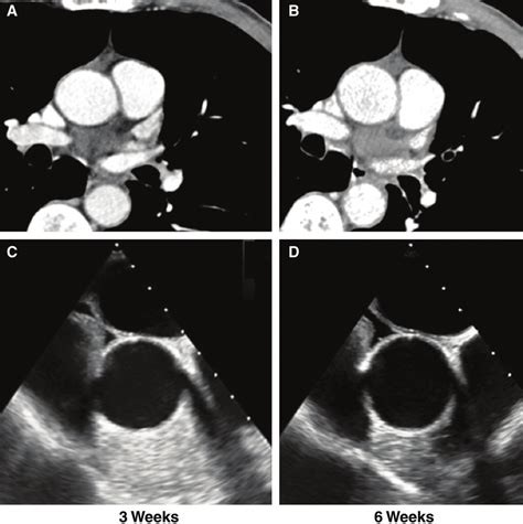 Follow Up Cardiac CT Images And TEE At 3 Weeks Post Stroke Showed