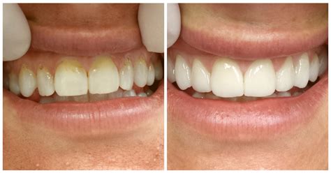 Porcelain Veneers Nyc Porcelain Veneers In Manhattan 209 Nyc Dental