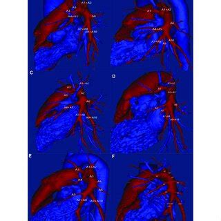 Example Of Right Pulmonary Artery Vascular Variation A1 Apical