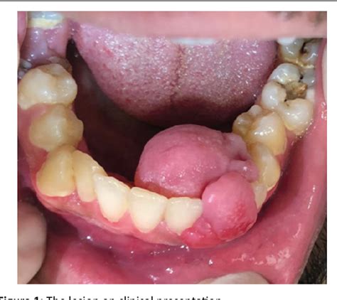 Peripheral Giant Cell Granuloma Vs Pyogenic Granuloma